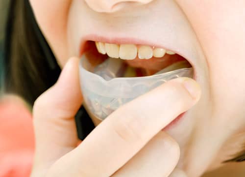 矯正装置のアップ