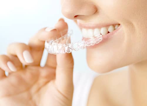 マウスピース型矯正治療