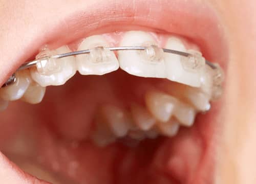 一般的な矯正を希望の方