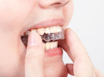 マウスピース型矯正治療